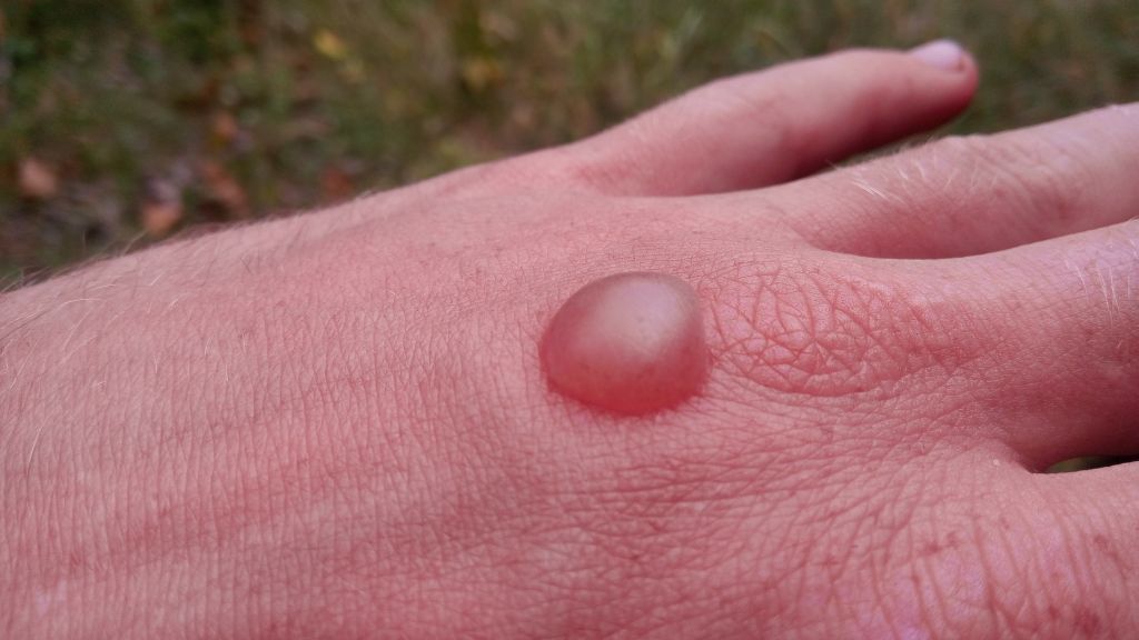Chvilku jsem nedával pozor, a bolševník mě nepříjemně žahnul.